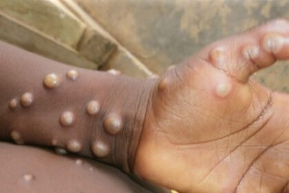 Outbreak of MPOX in Pakistan three patients confirmed know the symptoms of this dangerous disease