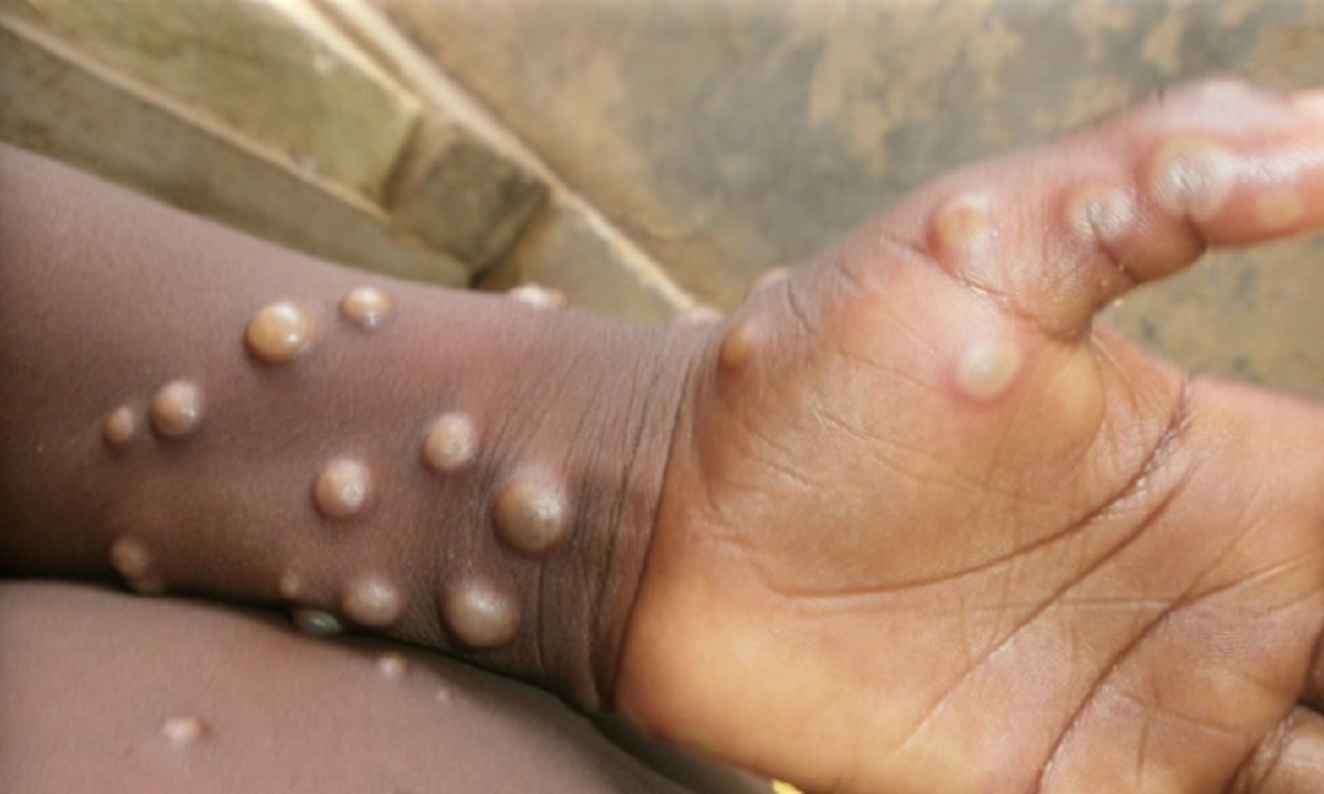 Outbreak of MPOX in Pakistan three patients confirmed know the symptoms of this dangerous disease